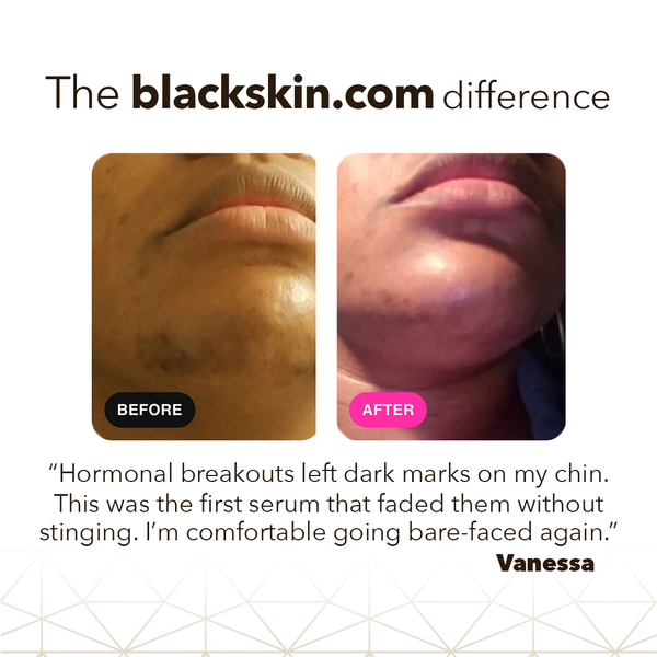 Intensive Dark Spot Serum- with Alpha Arbutin