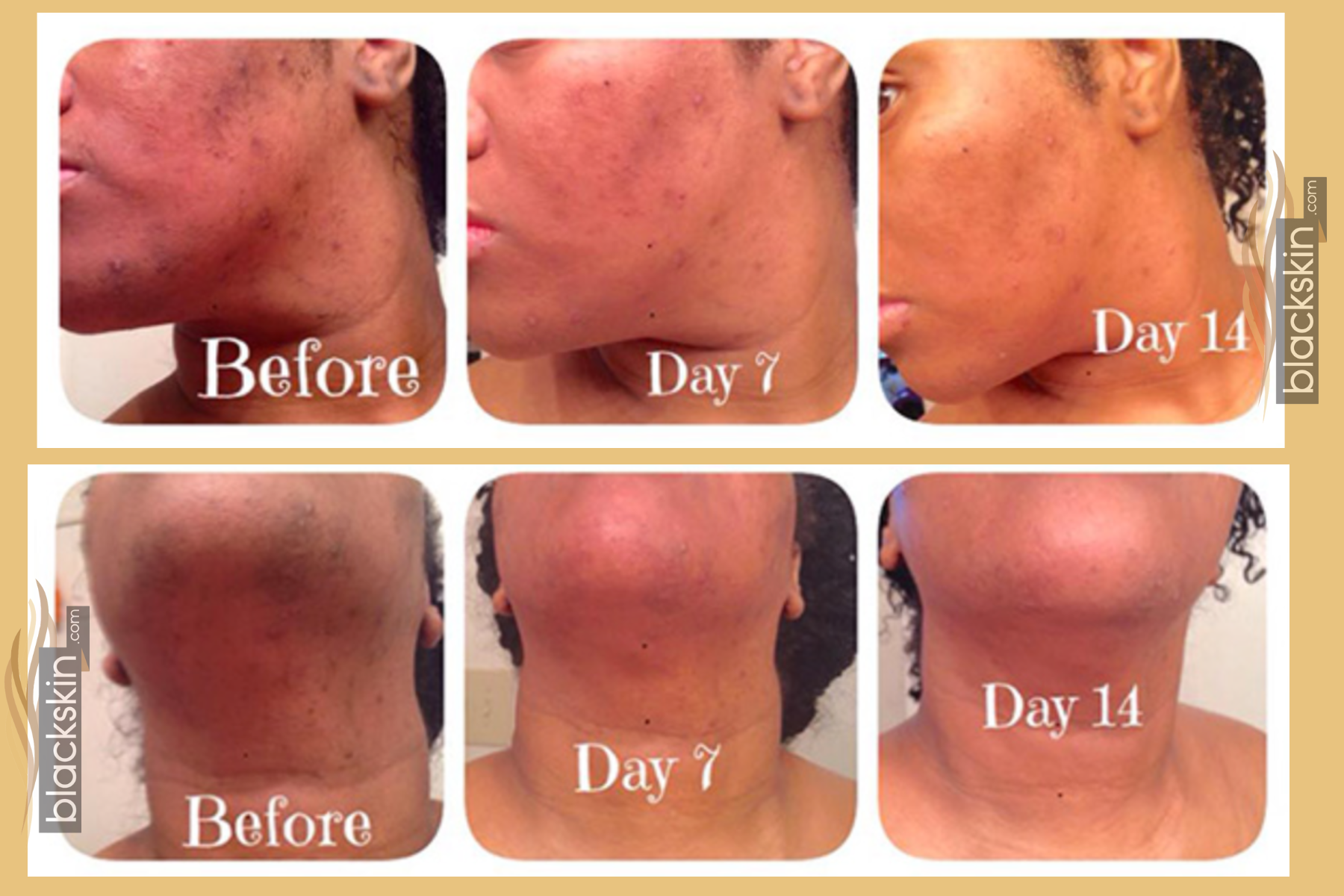 Black Skin Care Treatment of Dark Spots on black skin , acne