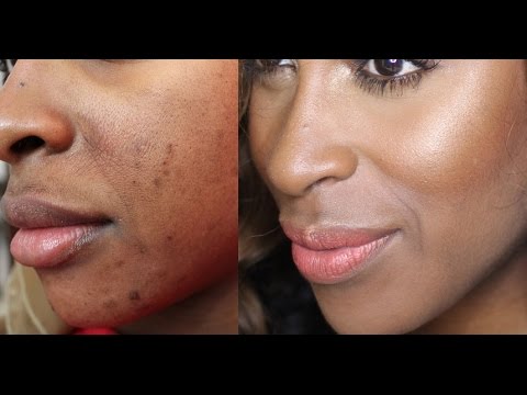 Stop Facial Hair Serum - Blackskin.com Product for Black skin , Dark Marks , Acne on Black Skin. Hyper pigmentation